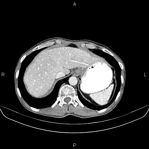 Colon adenocarcinoma - hepatic flexure (Radiopaedia 85635-101395 A 16).jpg