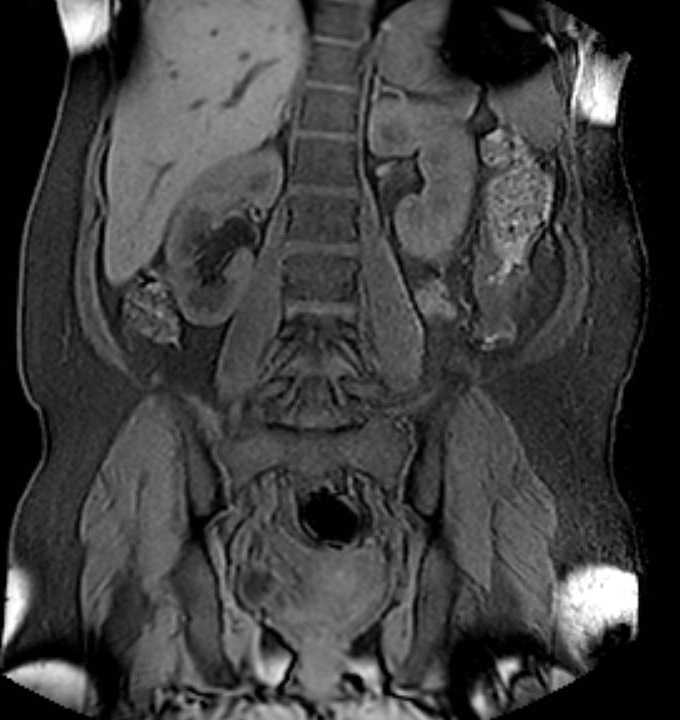 Colon adenocarcinoma with Krukenberg tumors, advanced pregnancy (Radiopaedia 67279-76645 E 62).jpg