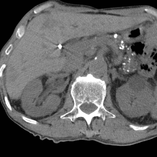 Colon cancer with calcified liver metastasis (Radiopaedia 74423-85309 Axial non-contrast 30).jpg