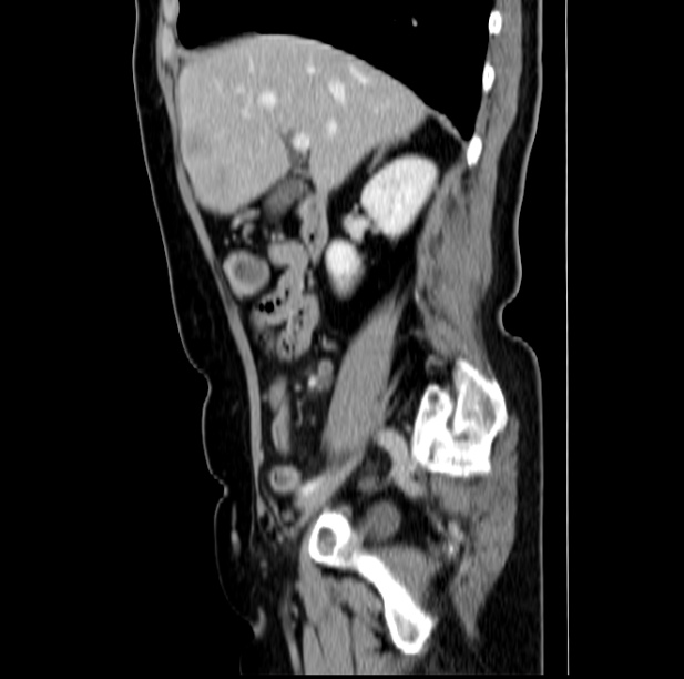 Colon carcinoma with hepatic metastases (Radiopaedia 29477-29961 C 19).jpg