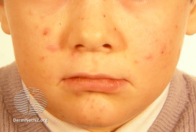 File:Infantile acne (DermNet NZ acne-infantile-acne4).jpg