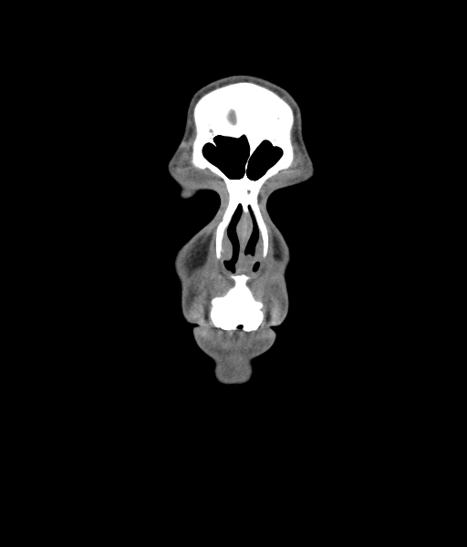 File:Nasal pyogenic granuloma (lobular capillary hemangioma) (Radiopaedia 85536-101244 Coronal non-contrast 45).jpg