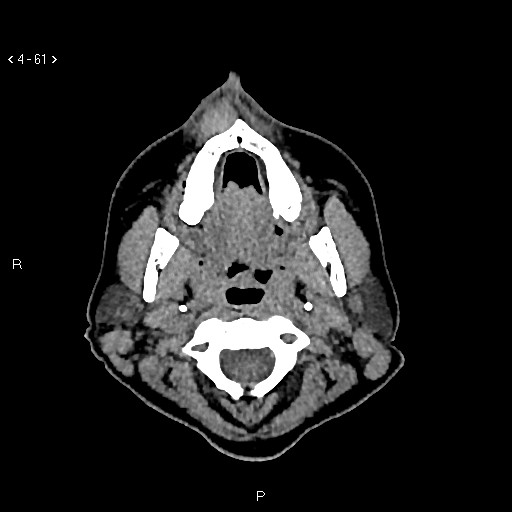 Nasolabial cyst (Radiopaedia 75125-86194 Axial non-contrast 23).jpg
