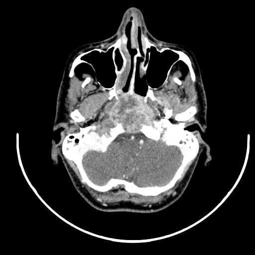 Nasopharyngeal carcinoma - infiltrating the clivus (Radiopaedia 62583-70875 Axial Post contrast 14).jpg