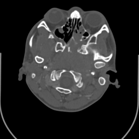 Nasopharyngeal carcinoma with skull base invasion (Radiopaedia 53415-59705 Axial bone window 33).jpg