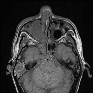 Nasopharyngeal carcinoma with skull base invasion (Radiopaedia 59258-66600 B 12).jpg