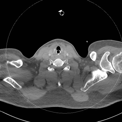 Neck CT angiogram (intraosseous vascular access) (Radiopaedia 55481-61945 B 143).jpg