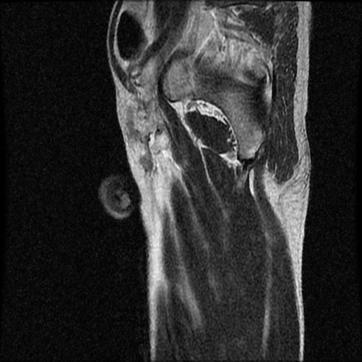 File:Necrotizing epididymo-orchitis with intra-testicular abscess (Radiopaedia 29397-29860 Sagittal T2 2).jpg