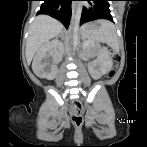 File:Neonatal neuroblastoma (Radiopaedia 56651-63438 Coronal non-contrast 34).jpg