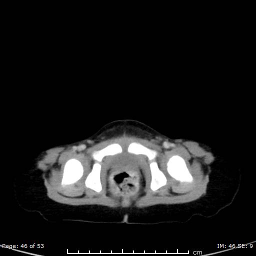 Nephroblastomatosis (Radiopaedia 41934-44935 A 46).jpg
