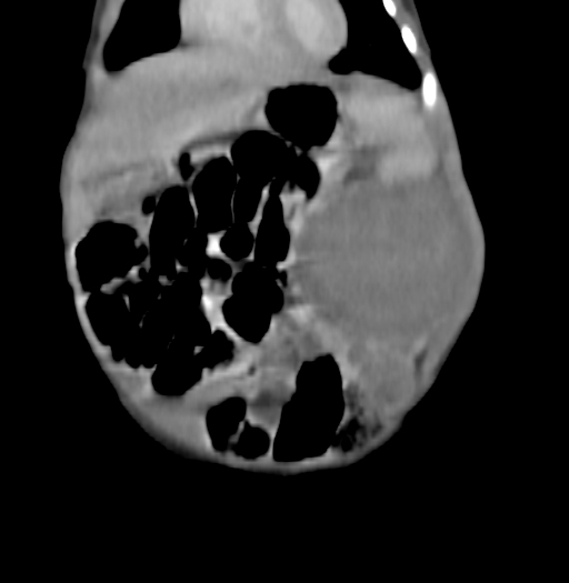 Nephroblastomatosis (Radiopaedia 71294-81607 B 95).jpg