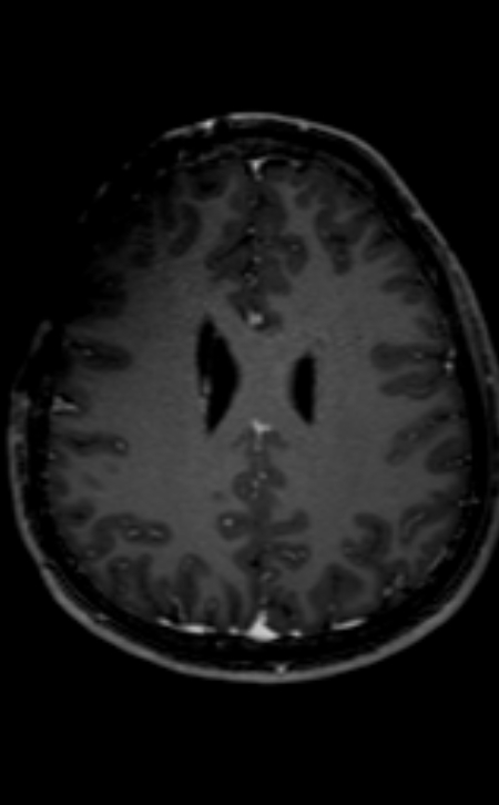 Neuro-Behçet disease (Radiopaedia 90112-107294 Axial T1 C+ 100).jpg