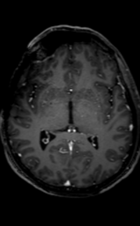 Neuro-Behçet disease (Radiopaedia 90112-107294 Axial T1 C+ 132).jpg