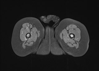File:Neuroblastoma with bone metastases (Radiopaedia 67080-76414 Axial T1 C+ fat sat 35).jpg