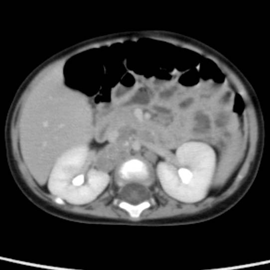 Neuroblastoma with skull metastases (Radiopaedia 30326-30960 C 25).jpg