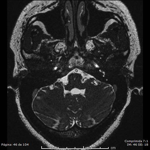 Neurocysticercosis (Radiopaedia 58636-65832 I 46).jpg