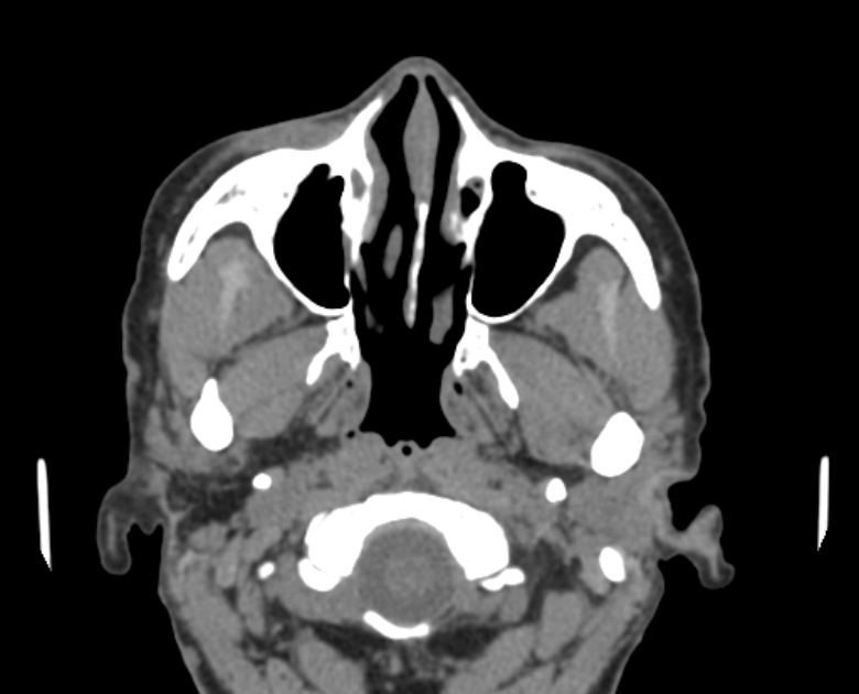 Neurofibromatosis type 1- orbital manifestations (Radiopaedia 49391-54511 Axial non-contrast 28).jpg