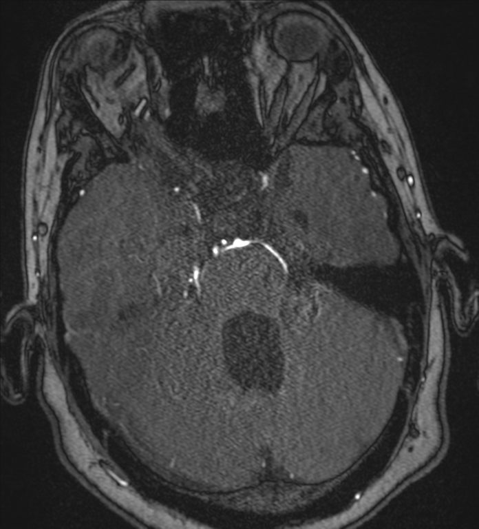 Neurofibromatosis type 1 - head and neck - CNS manifestations (Radiopaedia 49910-55188 Axial MRA 24).png