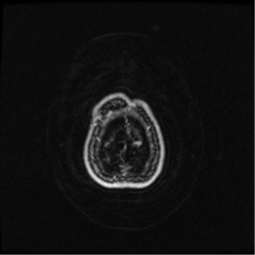 Neurofibromatosis type 2 (Radiopaedia 45229-49244 Axial T1 C+ 111).png