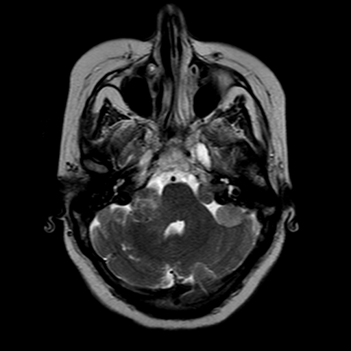 File:Neurofibromatosis type 2 (Radiopaedia 8713-9518 Axial T2 19).jpg
