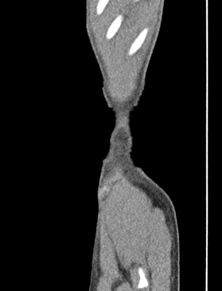 File:Neurogenic bladder (Radiopaedia 29058-29421 Coronal non-contrast 63).jpg