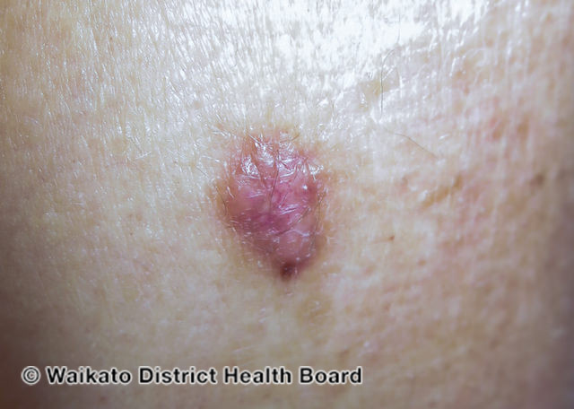 File:Nodular basal cell carcinoma, arm (DermNet NZ nbcc-arm-21-wdhb).jpg