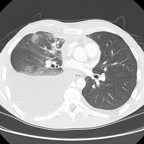 File:Non-Hodgkin lymphoma involving lung (Radiopaedia 29094-29470 Axial lung window 37).jpg