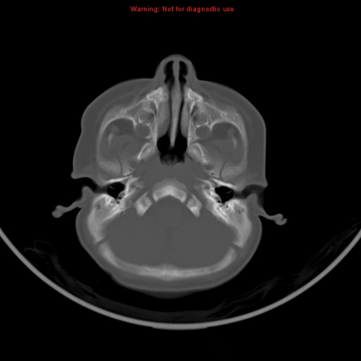 File:Non-accidental injury - bilateral subdural with acute blood (Radiopaedia 10236-10765 Axial bone window 4).jpg