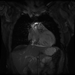 File:Non-compaction of the left ventricle (Radiopaedia 38868-41062 Coronal SSFP 2D FS 8).jpg