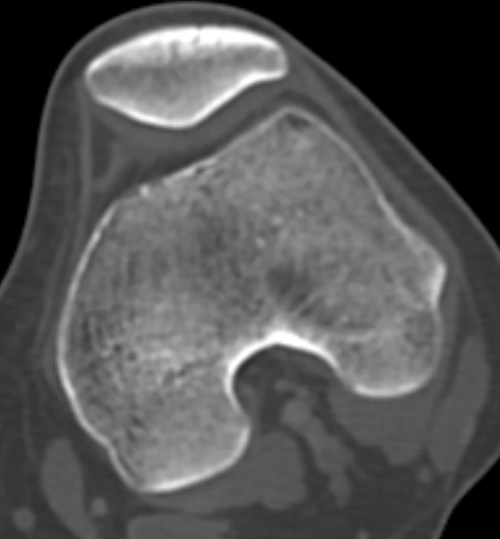 Non-ossifying fibroma - femur (Radiopaedia 82786-97042 Axial bone window 51).jpg