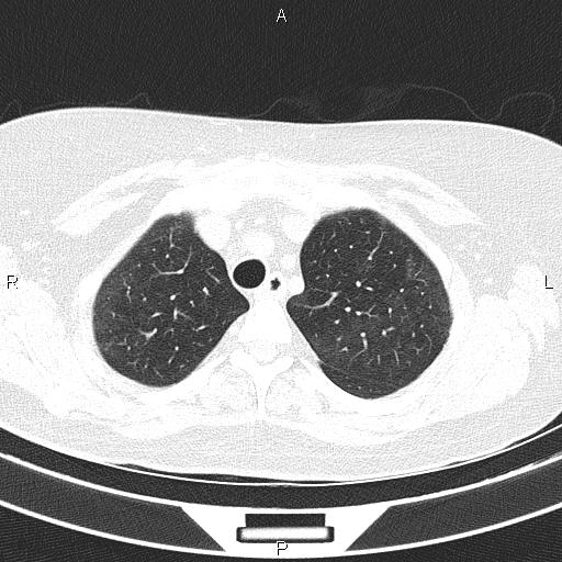 Non-specific interstitial pneumonia (Radiopaedia 83185-97567 Axial lung window 17).jpg