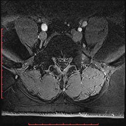 Non Hodgkin's lymphoma with metastasis to spine (Radiopaedia 54844-61103 Axial T1 C+ fat sat 7).jpg