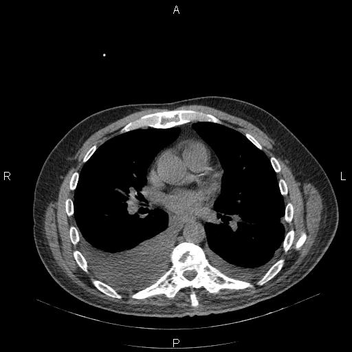 File:Non Hodgkin lymphoma in a patient with ankylosing spondylitis (Radiopaedia 84323-99624 Axial non-contrast 19).jpg