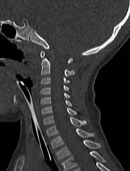 File:Normal CT cervical spine - pediatric (Radiopaedia 52549-58462 Sagittal bone window 91).jpg