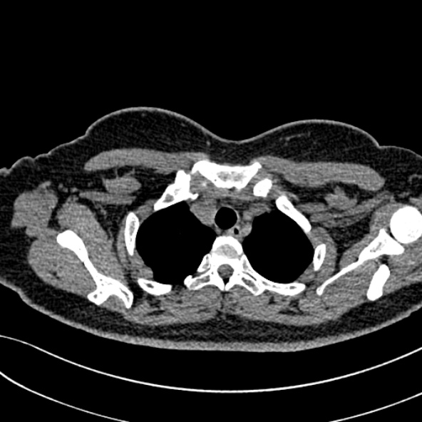 Normal CT chest- adult female (Radiopaedia 52522-58428 Axial non-contrast 24).jpg