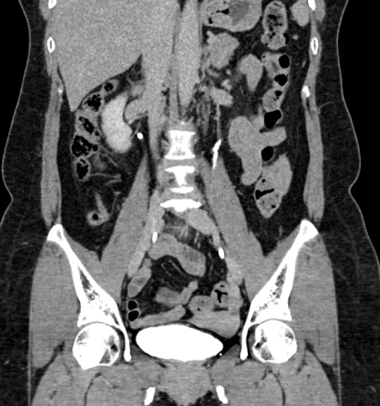 Normal CT intravenous urogram (Radiopaedia 39444-41759 A 271).jpg