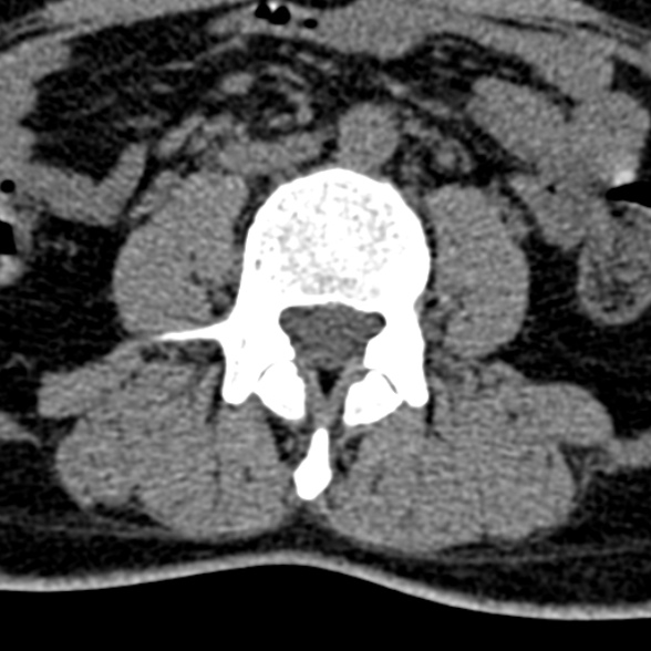 Normal CT lumbar spine (Radiopaedia 53981-60118 Axial non-contrast 59).jpg