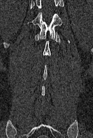 Normal CT lumbar spine (Radiopaedia 53981-60118 Coronal bone window 59).jpg