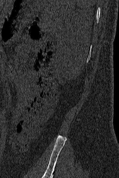 File:Normal CT lumbar spine (Radiopaedia 53981-60118 Sagittal bone window 109).jpg