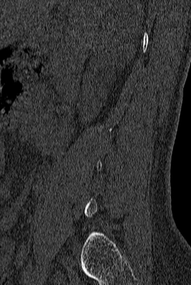File:Normal CT lumbar spine (Radiopaedia 53981-60118 Sagittal bone window 5).jpg