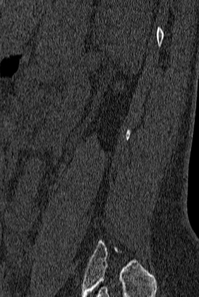 File:Normal CT lumbar spine (Radiopaedia 53981-60118 Sagittal bone window 85).jpg