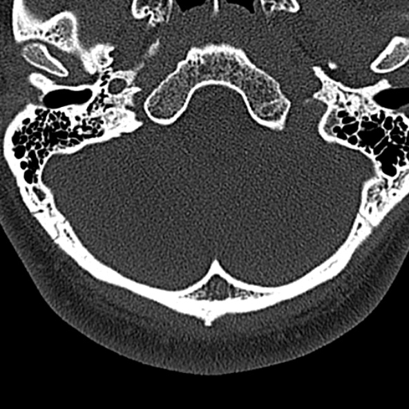 File:Normal CT of the cervical spine (Radiopaedia 53322-59305 Axial bone window 20).jpg