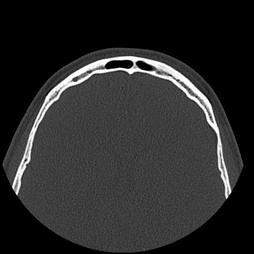 Normal CT paranasal sinuses (Radiopaedia 42286-45390 Axial bone window 13).jpg