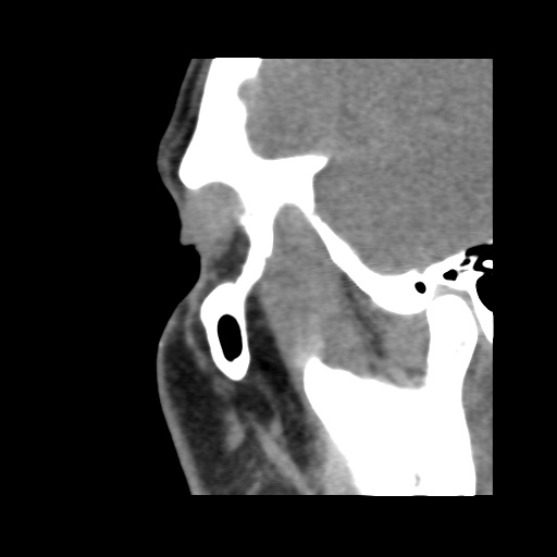 Normal CT paranasal sinuses (Radiopaedia 42286-45390 F 121).jpg