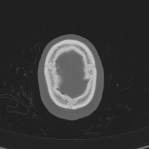 Normal CT skull (Radiopaedia 40798-43459 A 146).png