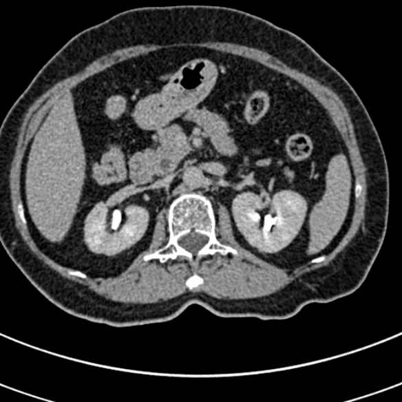 File:Normal CT split bolus study of the renal tract (Radiopaedia 48631-53634 Axial split bolus 58).jpg
