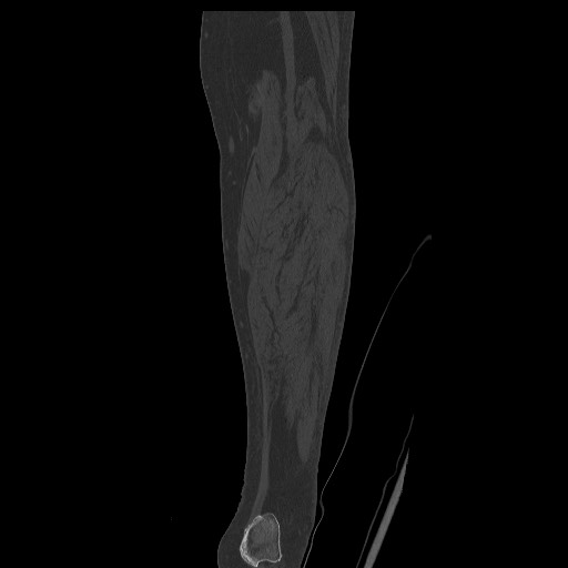 Normal CT tibia and fibula (Radiopaedia 51195-56848 Coronal non-contrast 52).jpg