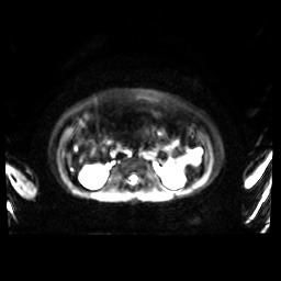 Normal MRI abdomen in pregnancy (Radiopaedia 88001-104541 Axial DWI 30).jpg