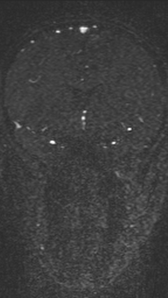 Normal MRI brain with MRV- teenager (Radiopaedia 49425-54553 Coronal MRV 98).jpg