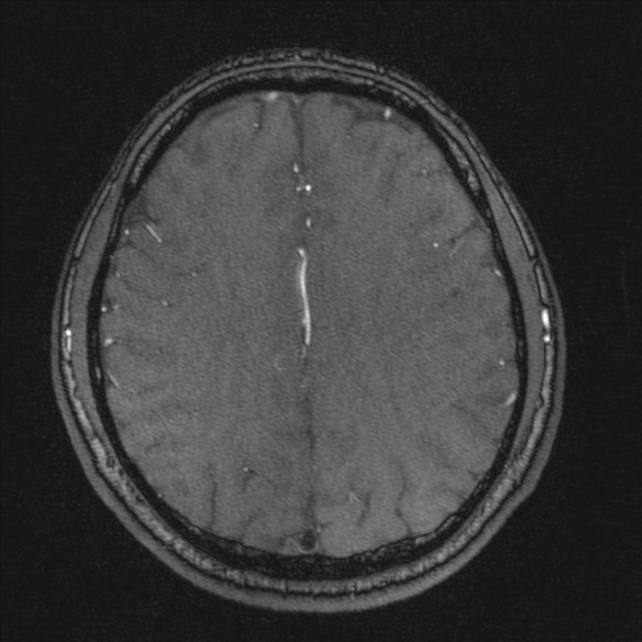 Normal brain MRI including MRA (Radiopaedia 48748-53763 Axial MRA 150).jpg